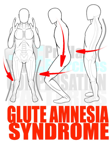 PreHab Exercise eBook - Alignment - Compensation Patterns - Glute Amnesia with Direction Lines