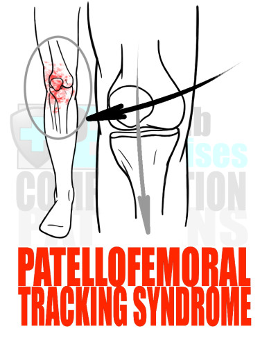 PreHab Exercise eBook - Compensation Patterns - Patellofemoral Tracking Syndrome with Direection Lines
